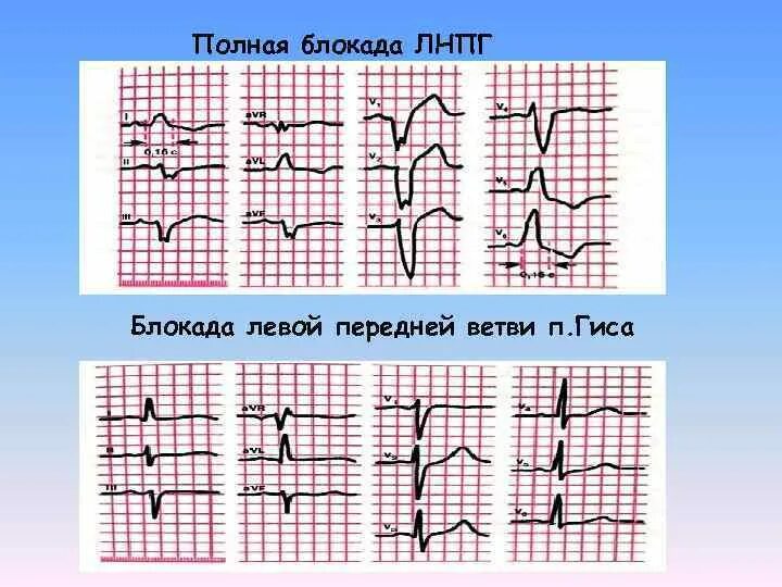 Неполная блокада передней. ЭКГ при блокаде передней ветви левой ножки пучка Гиса. Блокада левой пучка Гиса на ЭКГ. Неполная блокада передней ветви ЛНПГ на ЭКГ. ЭКГ при блокаде передней ветви левой ножки пучка Гиса (ЛНПГ).