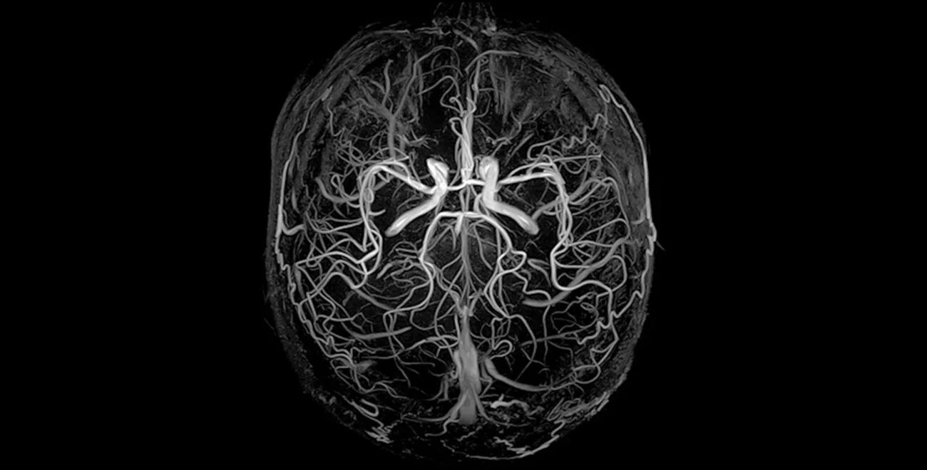 Церебральная ангиодистония что это. Магнитно-резонансная ангиография головного мозга. МР венография сосудов головного мозга. Мрт ангиография сосудов головного мозга. Мрт головного мозга с ангиографией.