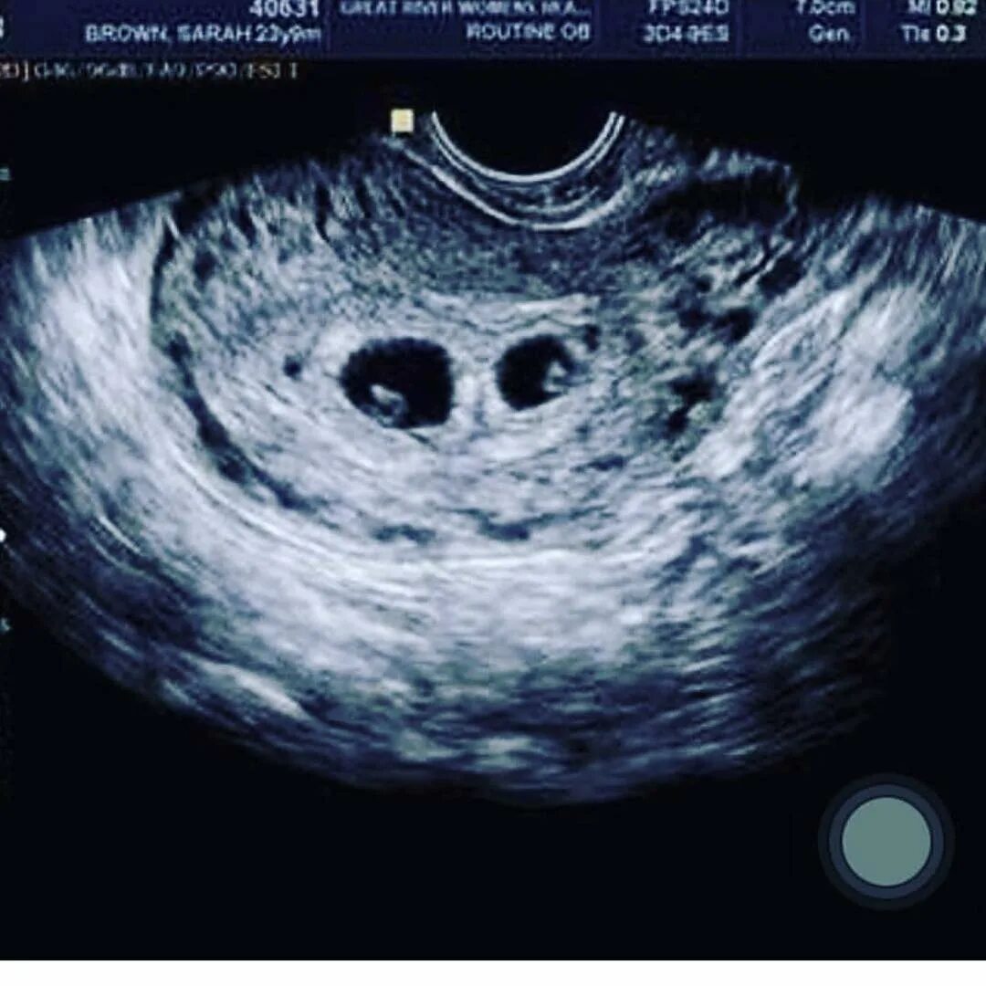 двойня на 5 неделе беременности. узи на 5 неделе беременности двойня. узи на 4 неделе беременности двойня. узи на 5 неделе беременности двойня. двойня на 5 неделе беременности.