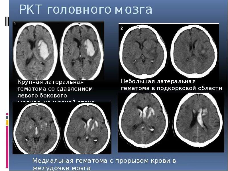 Опухоли желудочков. РКТ головного мозга желудочки. Желудочки головного мозга кт анатомия. Геморрагический инсульт головного мозга кт. Желудочки головного мозга на кт.