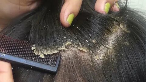 Перхоть видео
