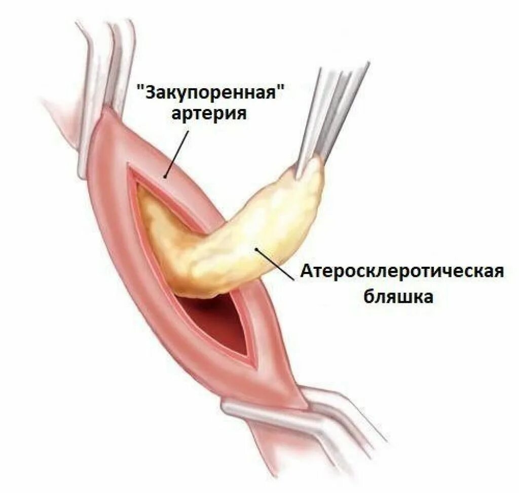 Шунтирование артерий нижних конечностей. Сосудистое шунтирование.