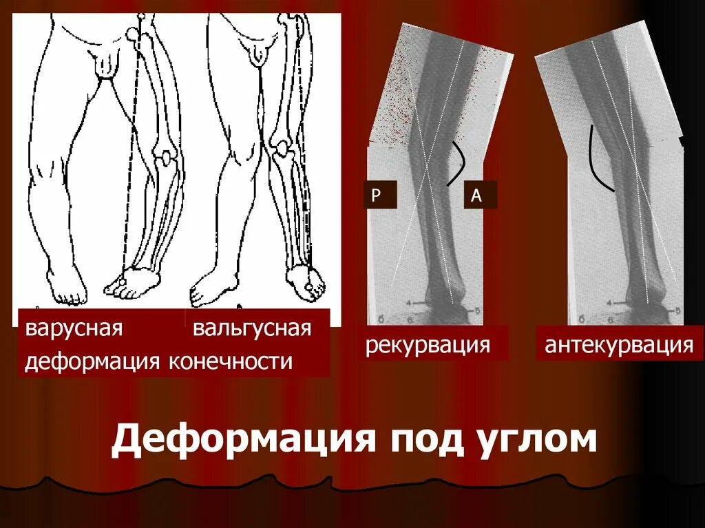 Деформация под. Варусная деформация большеберцовой кости. антекурвационная деформация конечности это. варусные и вальгусные деформации.