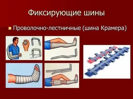 При каких переломах ставят