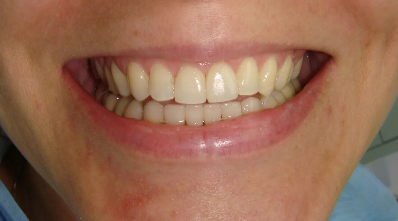 Винир прямой композитный. Прямые композитные виниры.