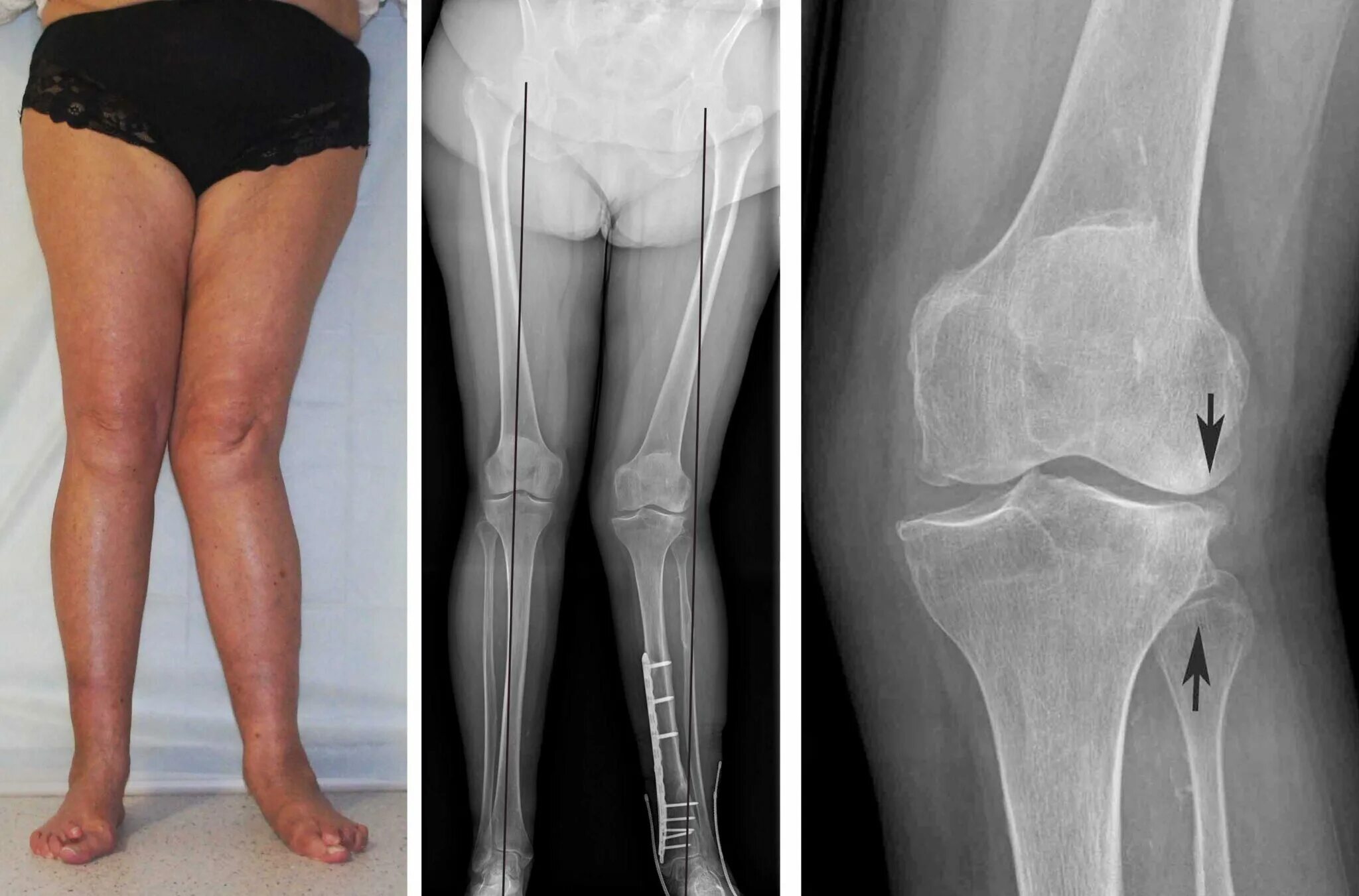 Гонартроз коленного сустава рентген. Гонартроз варусная деформация\. Варусная деформация коленных суставов. Варусная деформация коленных суставов артроз.
