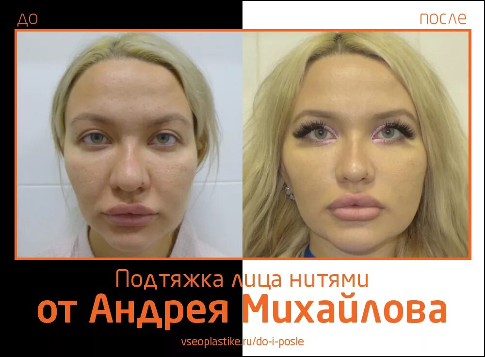 Николай анатольевич до и после пластики Перейти на страницу с картинкой