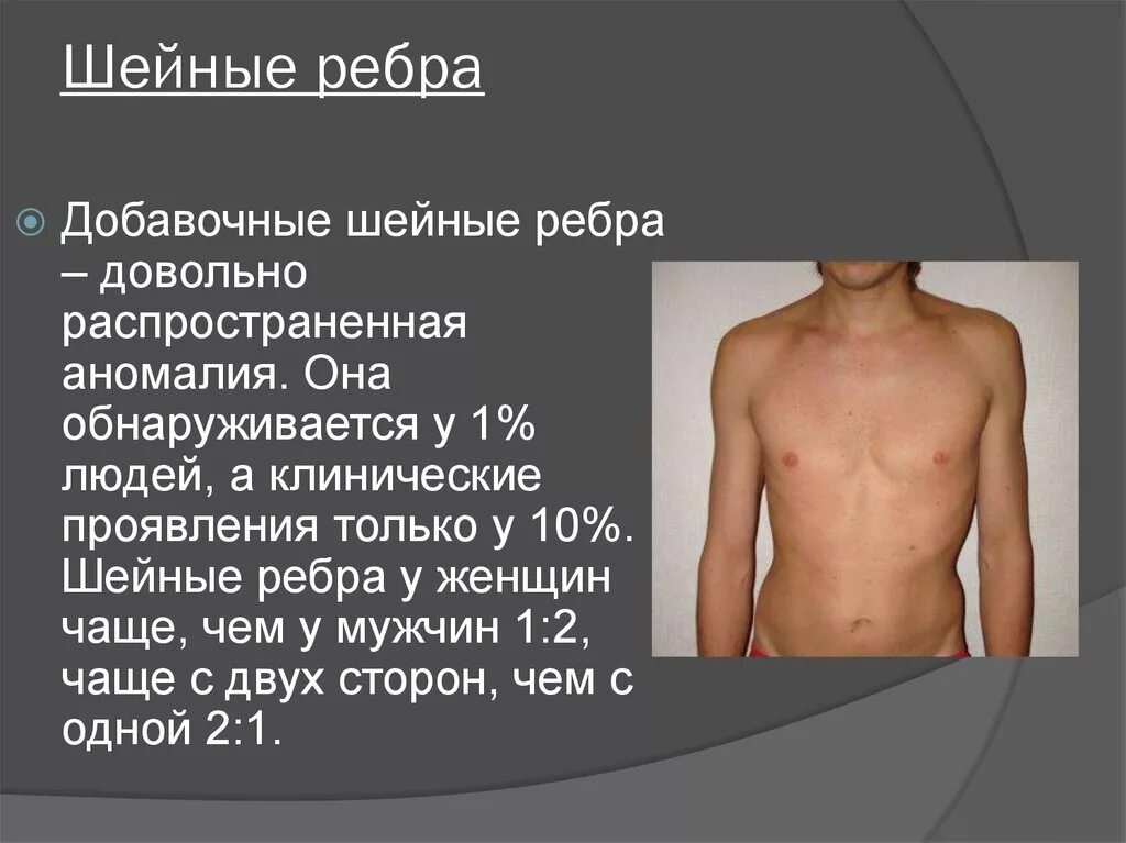 Хирургические заболевания грудной клетки. Шейные ребра с7 первой степени. Добавочное шейное ребро. Дополнительное шейное ребро. Дополнительные ребра у человека.