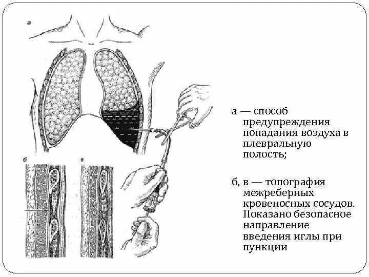 Попадание воздуха в полость. Плевральная пункция ориентиры. Плевральная пункция алгоритм. Пункция плевральной полости алгоритм. Плевральная пункция схема.