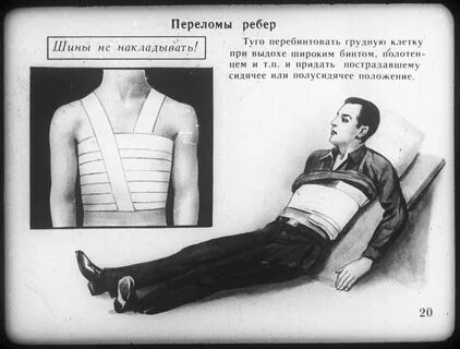 Как накладывается шина при переломе костей
