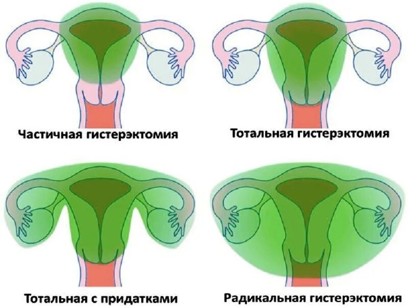 Тотальная матка