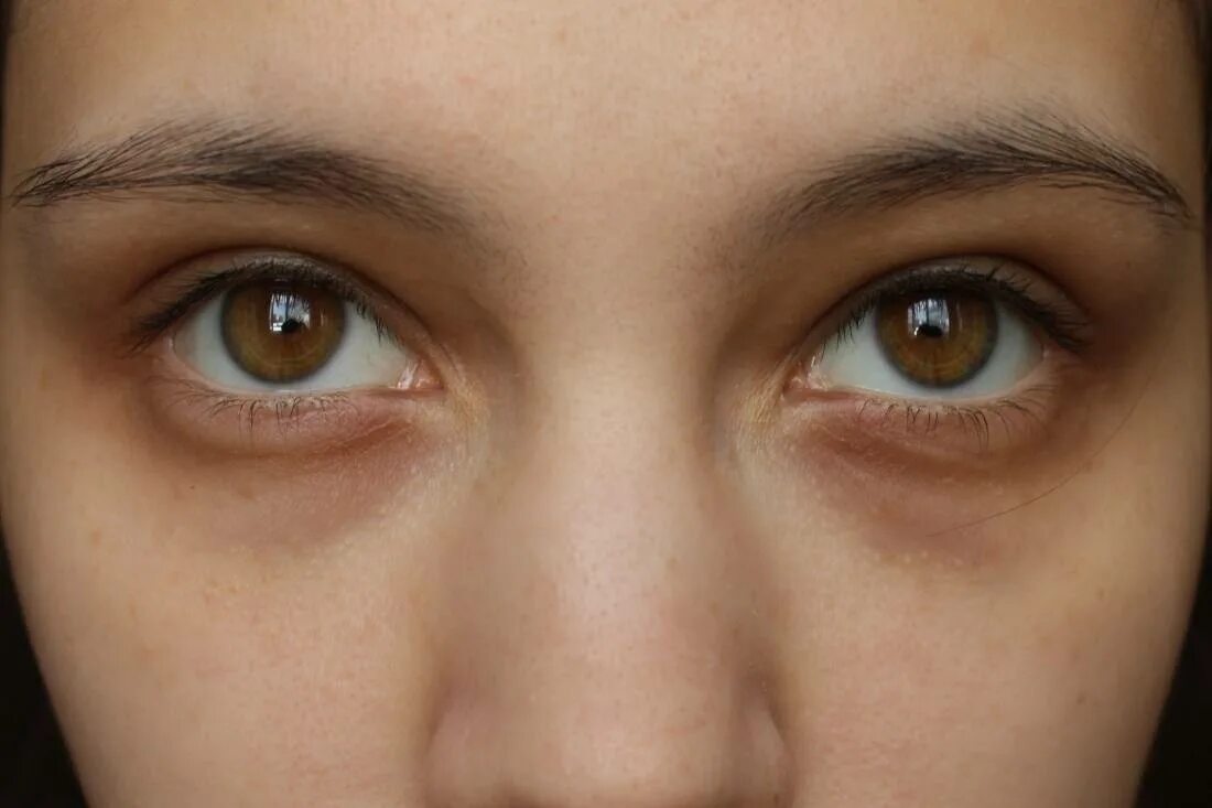 Темные круги под глазами женщин лечение. Тёмные круги пол глазами. Круги под глазами.