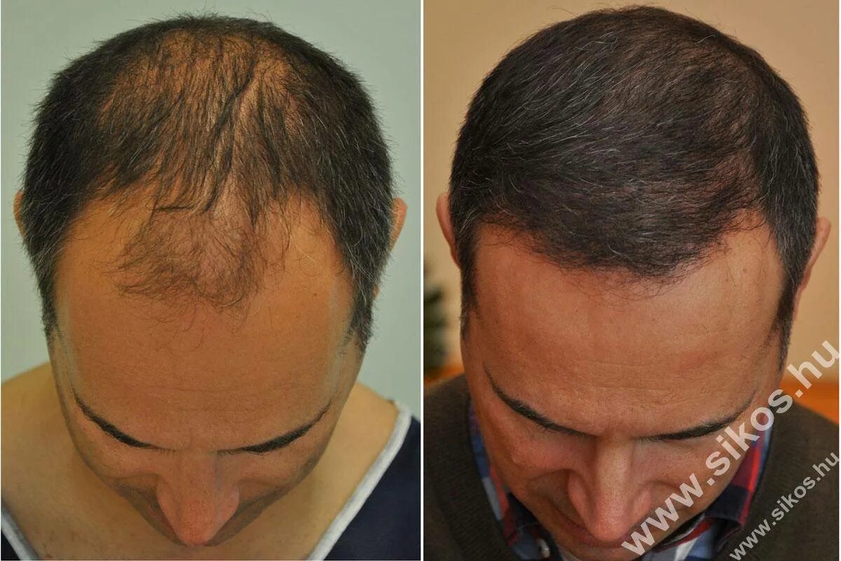 Пересадка волос у женщин. Пересадка волос в самаре. Пересадка волос в турции. Трансплантация волос до и после. Пересадка волос в самаре.