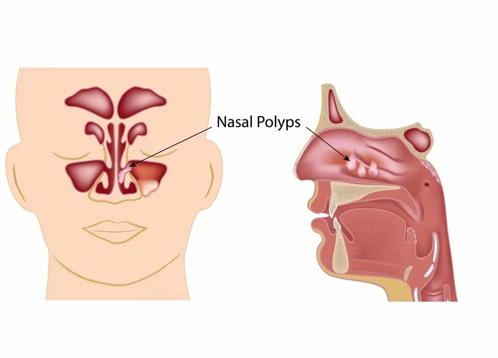 Originally seen on Buzzfeed... Nearly 35 million Americans suffer from sinus dis