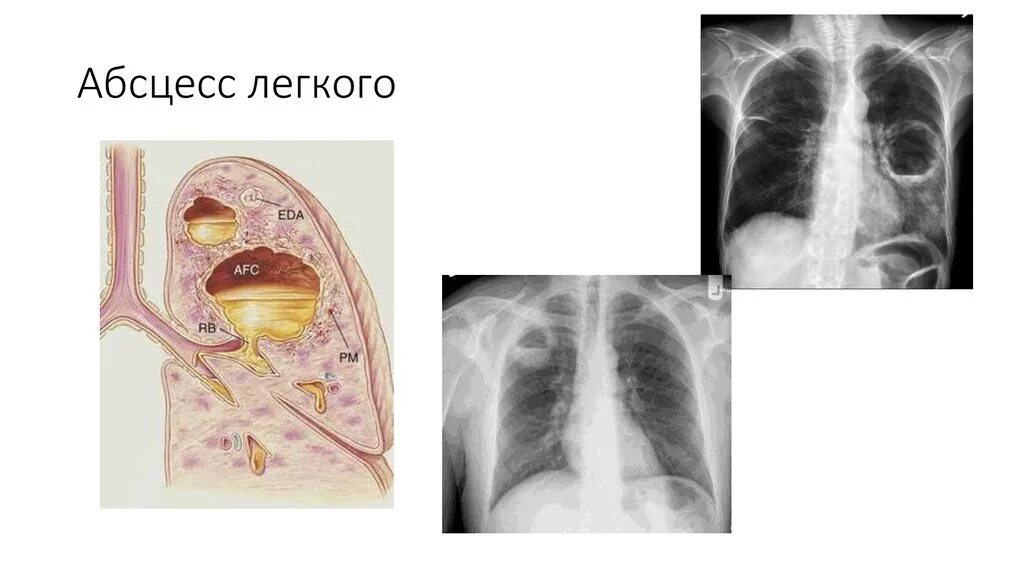 Гнойные абсцессы легких. Гнойная абсцедирующая пневмония. Пневмония с абсцессом легкого. Абсцесс легкого пневмония рентген. Дренирующийся абсцесс легкого.