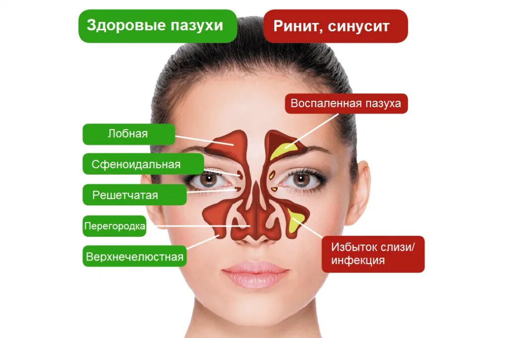 Синусит можно греть нос. Синусит придаточных пазух. Гайморовые пазухи, гайморит. Анатомия носовых пазух у человека. Носовые пазухи строение гайморит.