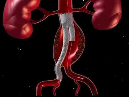 Abdominal aortic aneurysm