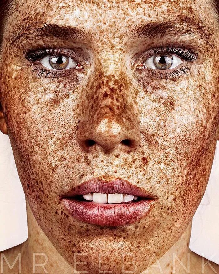 Freckles перевод. Ксеродерма Пигментосум. Лентиго, хлоазма, веснушки.