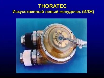 Сколько весит искусственный левый желудочек