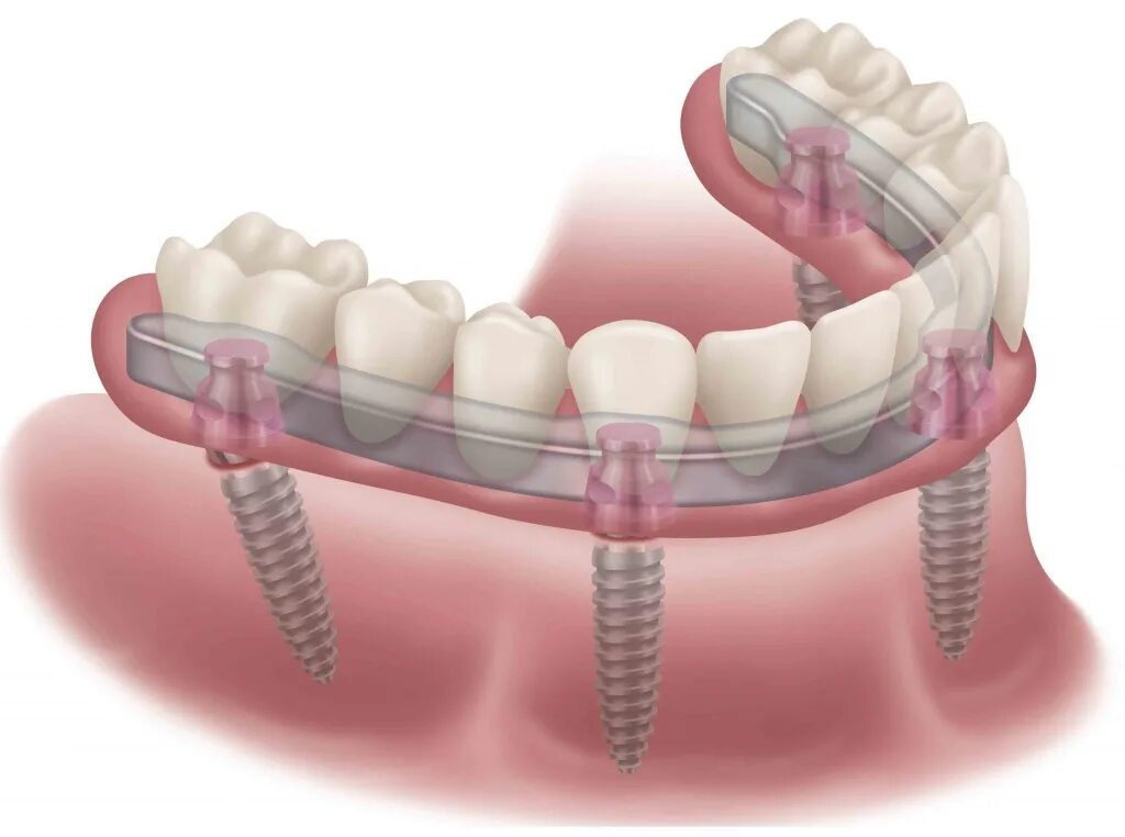 Несъёмный мостовидный протез челюсти. Несъемный мостовидный протез на 4 имплантах. Несъемные зубные протезы. Не сьенмые зубные протезы.