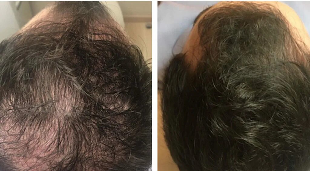 Мелатонин при алопеции. Мелатонин 03. Minoxidil serum для волос. Мелатонин при алопеции. Глицин мелатонин эвалар.