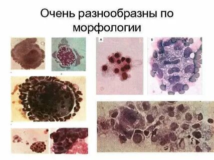 Макрофаги с гемосидерином