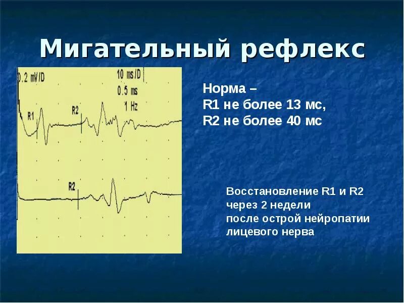Эмг сайт. Мигательный рефлекс электромиография. исследование мигательного рефлекса эмг. рефлекс мигательного рефлекса. мигательный рефлекс энмг.