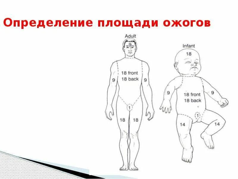 Опасные для жизни ожоги площадью. Площадь поражения при ожогах 2 степени. Ожоги по степени тяжести у детей.