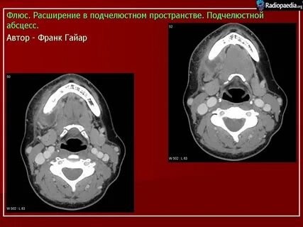Небные миндалины на кт
