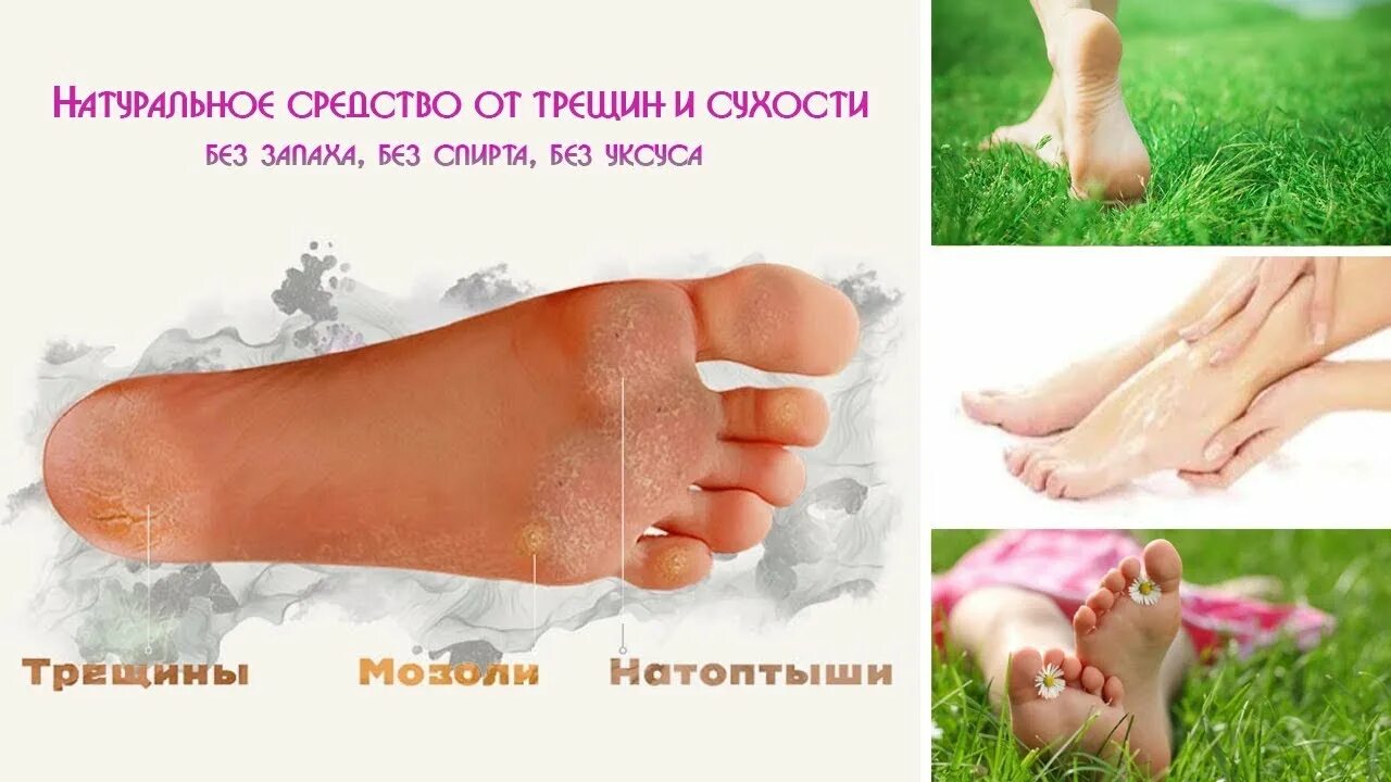 Сухость на стопах ног