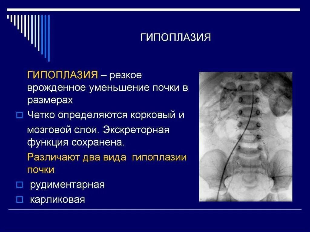 Уменьшение размеров почки. Аномалии почек гипоплазия. врожденная гипоплазия почки. гипоплазия левой почки. двусторонняя гипоплазия почек.