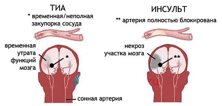 Транзиторный ишемический инсульт симптом. Транзиторная ишемия атака симптомы. Тиа и ишемический инсульт. Транзиторная ишемическая атака головного мозга симптомы.