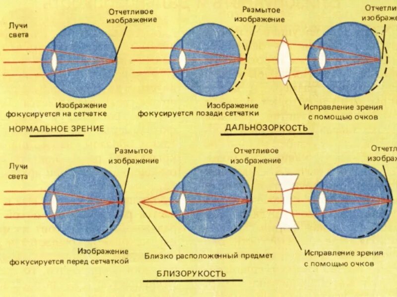 Почему зрение размытое. Причины испорченного зрения. близорукость изображение фокусируется перед сетчаткой. как портится зрение. почему портится зрение.