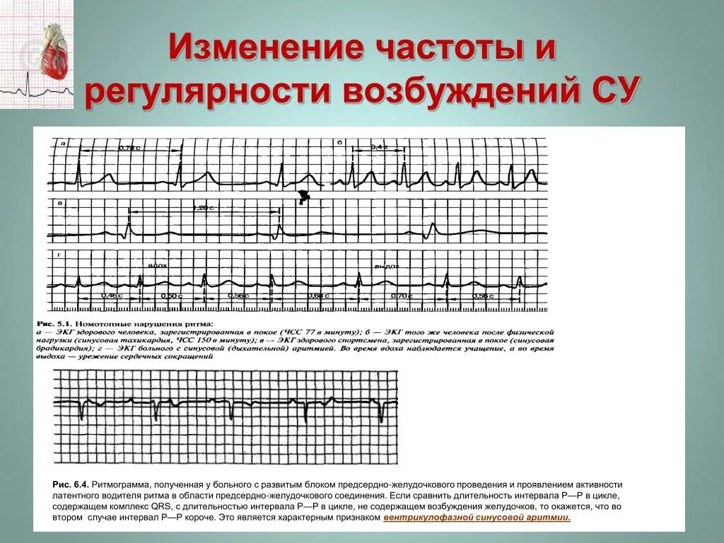 Вентрикулофазная синусовая аритмия на ЭКГ. Ритмограмма ЭКГ. ЭКГ при нарушениях функции возбудимости. ЭКГ при нарушении функции АВТОМАТИЗМА.