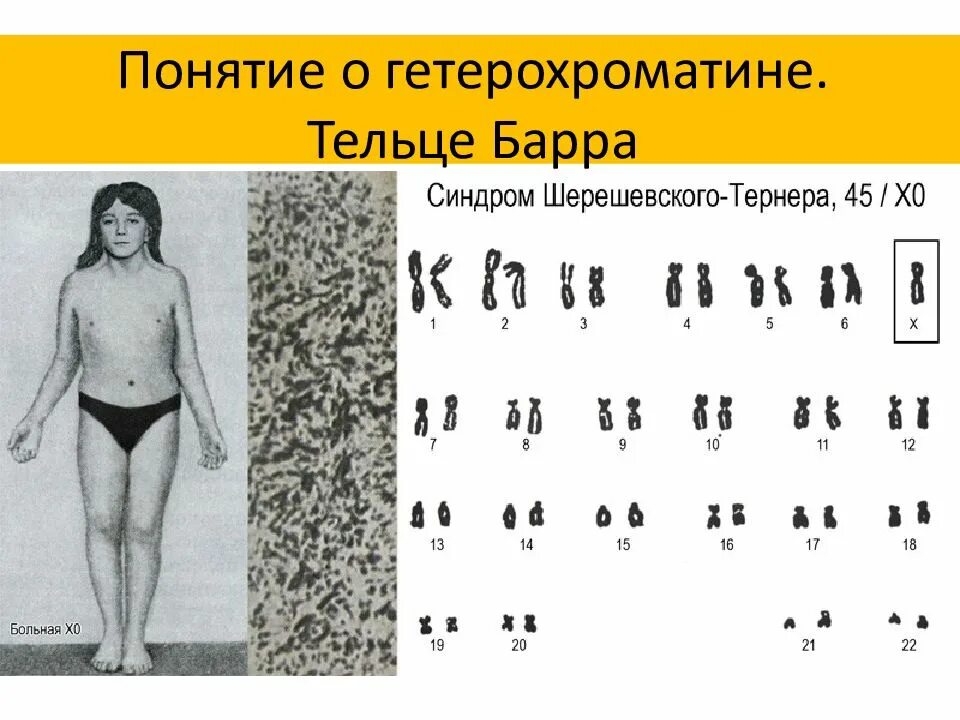 Таблица половой хроматин тельце Барра. Тельца Барра в кариотипе. Кариограмма синдрома Шерешевского Тернера. Синдром Шерешевского Тернера фенотип. Синдром тельце