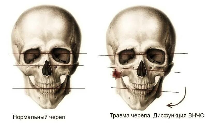 Боли костей лица. Челюстью(дисфункция ВНЧС). Нижнечелюстная ямка ВНЧС. Асимметрия нижней челюсти ВНЧС.