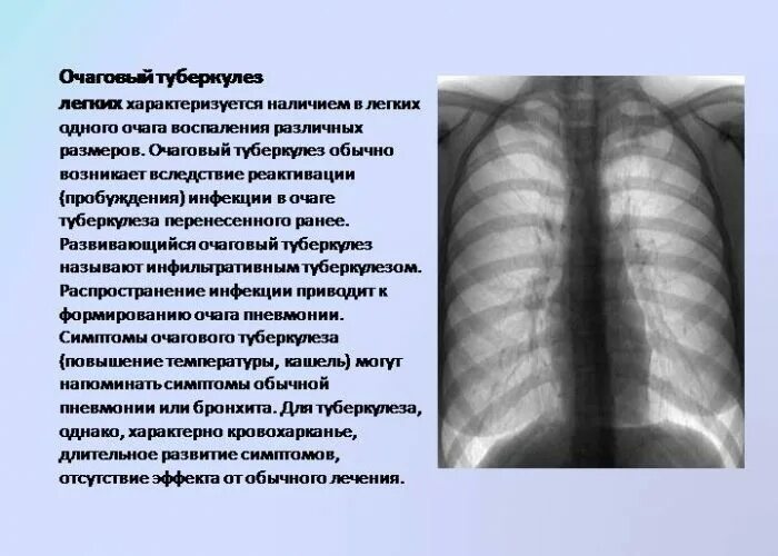 Очаговый туберкулез и туберкулема рентген. Очаг поражения туберкулезом легких. Формы очагового туберкулеза легких. Очаговый туберкулез симптомы.