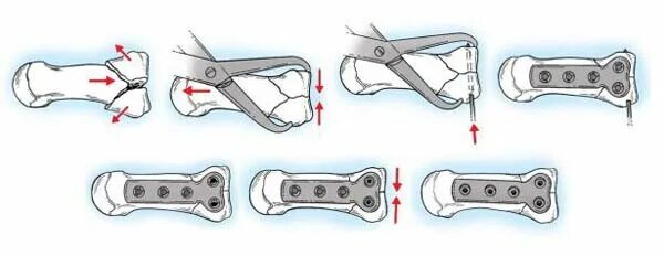 Остеосинтез пястной кости пластиной. Остеосинтез 5 пястной кости пластиной. Перелом пластины остеосинтеза. Остеосинтез спицами Киршнера пястных костей. Пластина в пальце