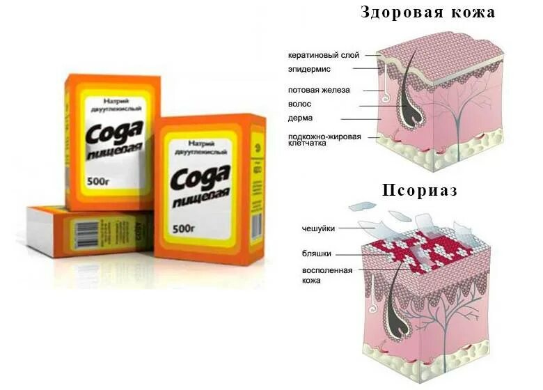 Кожному отзыв. Народные средства от псориаза. Псориаз народные средства. Лечение псориаза в домашних условиях. Народные методы от псориаза.