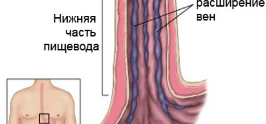 Варикозные вены пищевода мкб 10