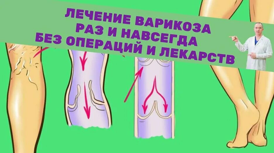 Варикозная болезнь нижних конечностей. Шишонин варикозная болезнь. Шишонин варикозная болезнь нижних конечностей.