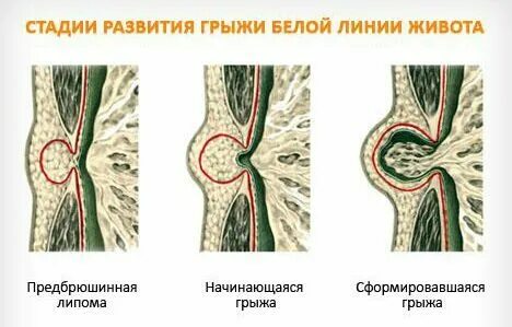 Лечение грыжи белой линии