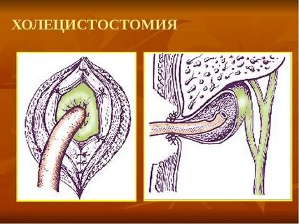 Холецистостомия операция