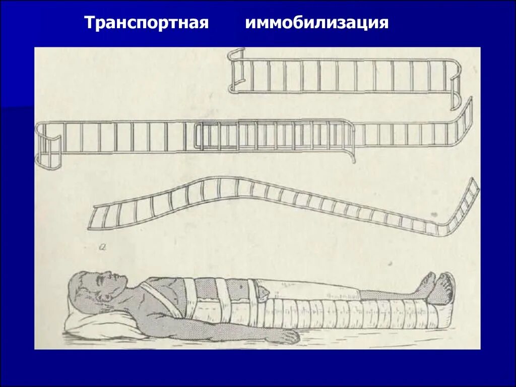 Шина крамера и дитерихса. Стандартные шины для иммобилизации. Пневматические шины для иммобилизации. Тесты транспортная иммобилизация. Иммобилизация при переломе бедренной кости.