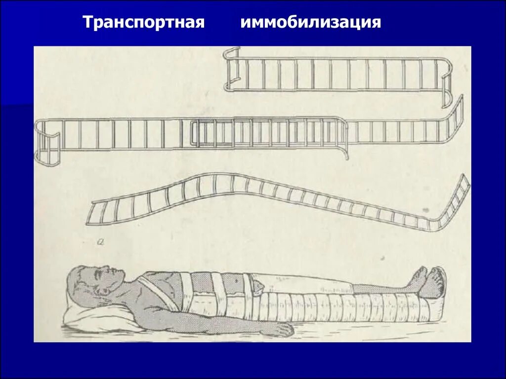 Догоспитальный этап при переломе. Транспортная иммобилизация травматология. Иммобилизация выполняется с целью. Транспортная иммобилизация военнослужащих. Этапы иммобилизации.