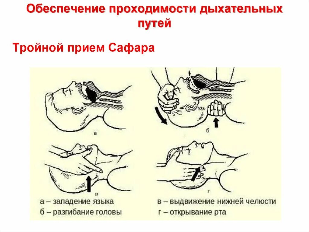 Тройной прием алгоритм. Приемы обеспечения проходимости дыхательных путей. СЛР обеспечение проходимости дыхательных путей. Восстановление проходимости дыхательных путей тройной прием. Восстановление проходимости дыхательных путей тройной прием Сафара.