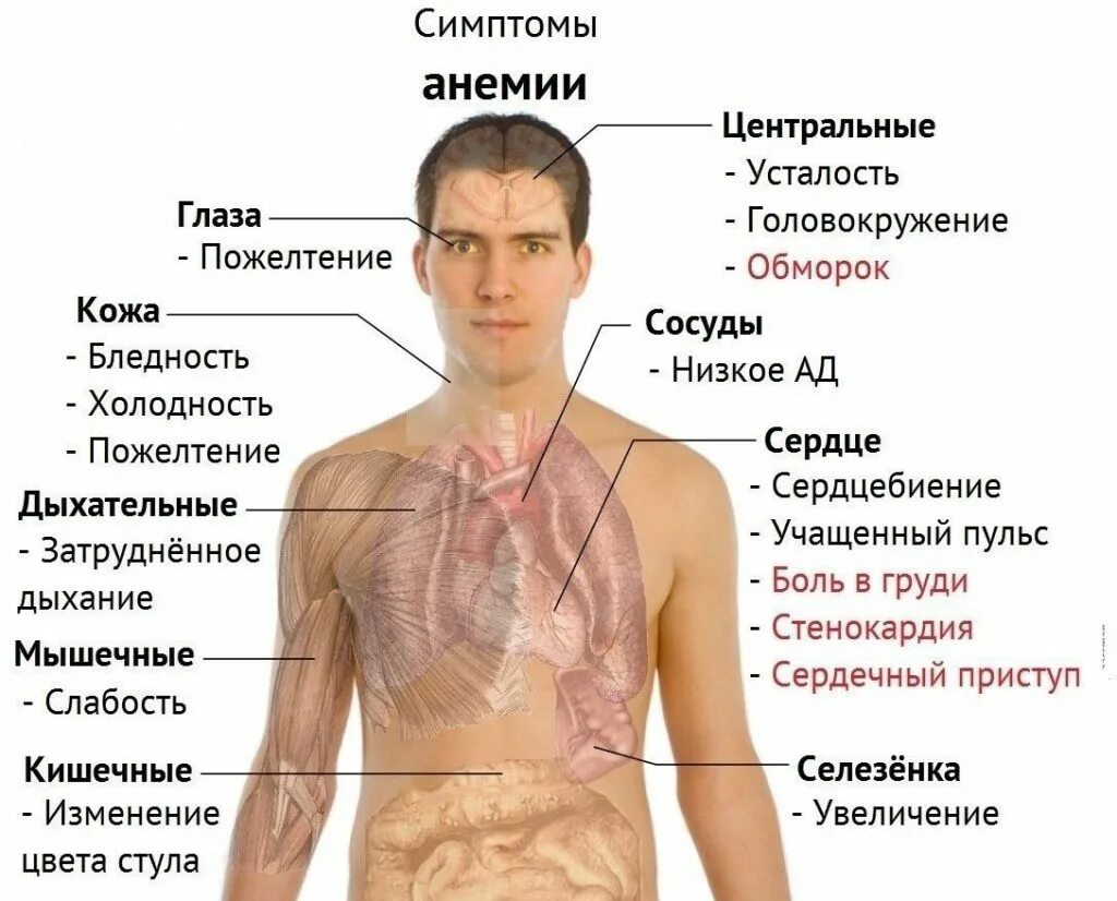 Признаки недомогания. Тяжелая анемия симптомы.