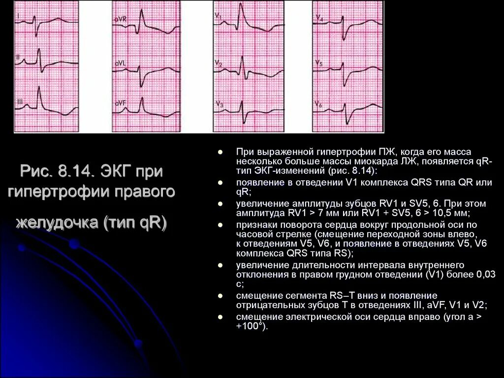 Гипертрофия миокарда лж что это. Правожелудочковая гипертрофия ЭКГ. Гипертрофия правого желудочка сердца на ЭКГ. ЭКГ синдром гипертрофии желудочков. S Тип гипертрофии правого желудочка на ЭКГ.
