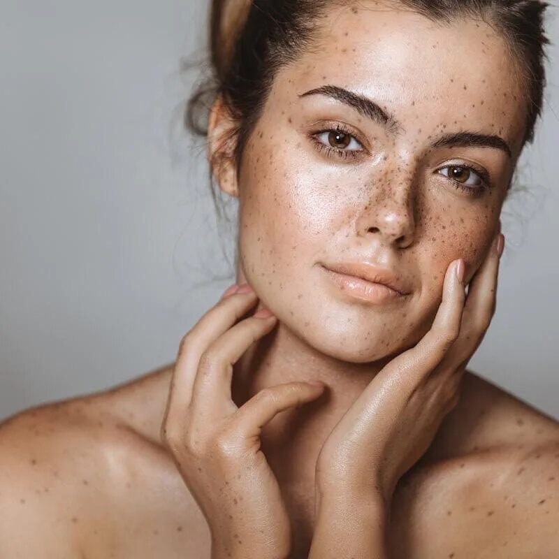 Очень проблемная кожа. Очень проблемная кожа. Девушка с проблемной кожей. Пигментные пятна постакне. Очень проблемная кожа.