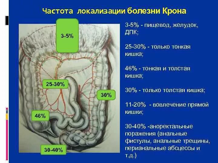 Болезнь крона лечение у взрослых кишечника. Болезнь крона тонкой кишки. Кишка при болезни крона. Болезни в толстом кишечнике. Локализация при болезни крона.